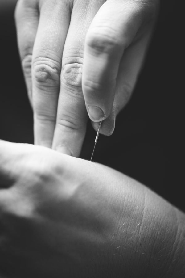 What are the benefits of acupuncture?