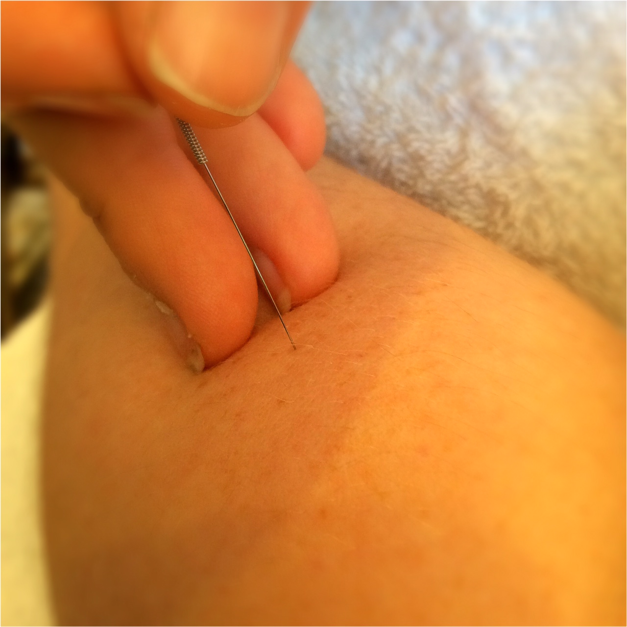 Dry Needling & Acupuncture … what’s the difference?