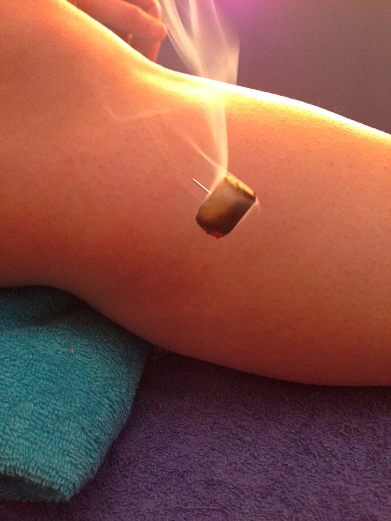Moxibustion…what is it?